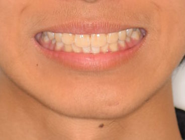 山陽小野田市 マウスピース矯正 インビザライン 専門サイト みやわき矯正歯科